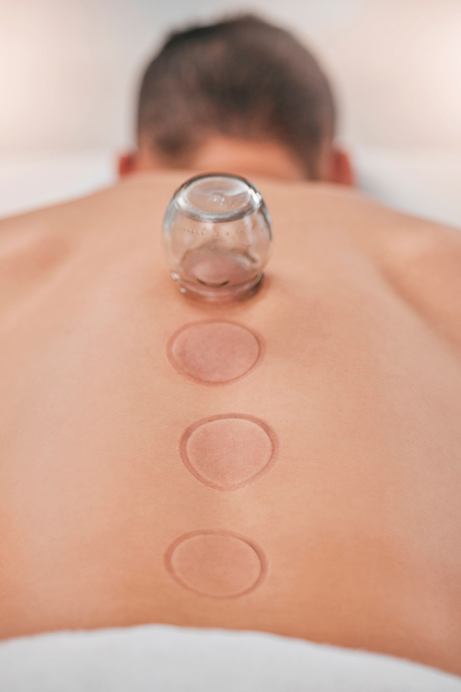 Cupping